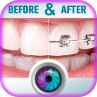 Teeth Braces Before and After